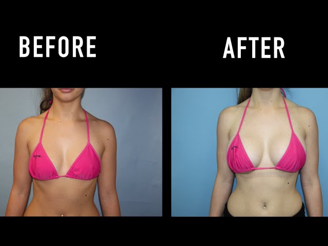 Natural breast implants: A closer look at realistic augmentation