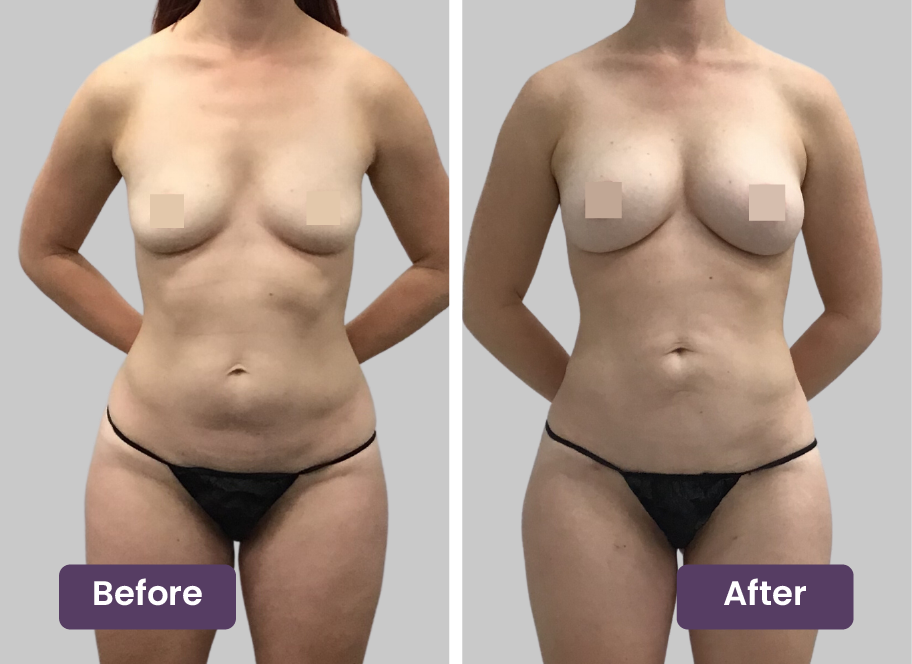 natural breast implants natural breast implants