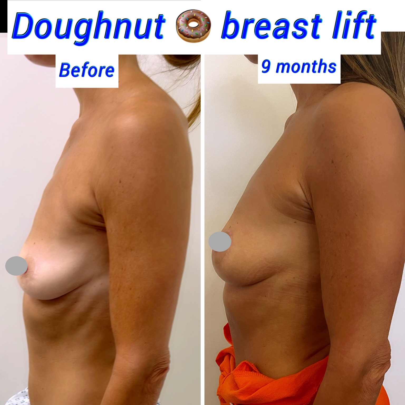 natural breast lift natural breast lift