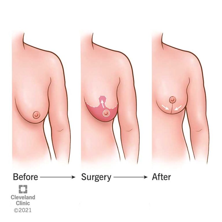 Natural breast lift: Restoring perkiness without implants