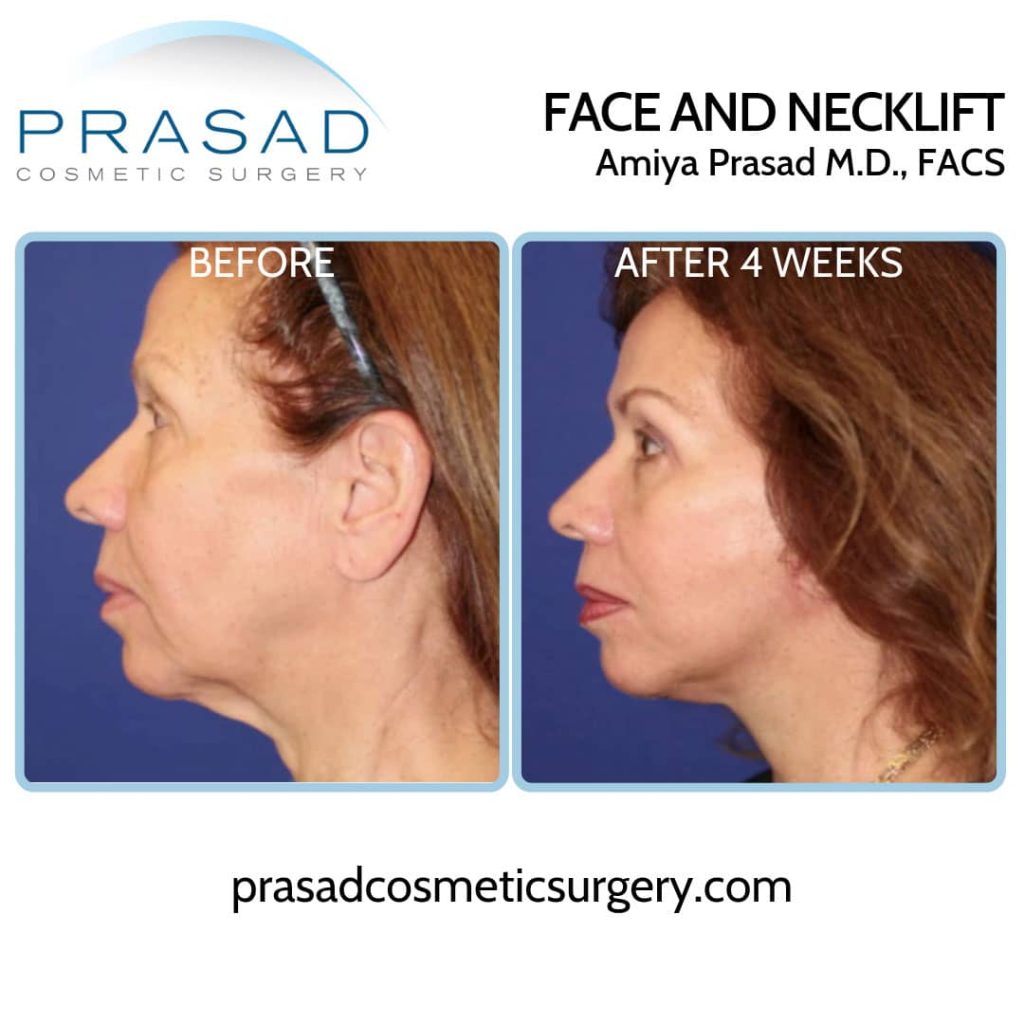 neck lift without surgery neck lift without surgery