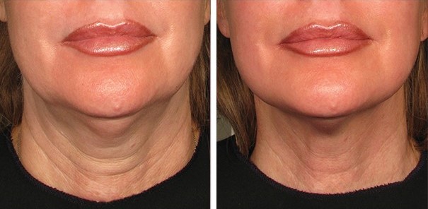 Neck lift without surgery: Non-invasive options to consider