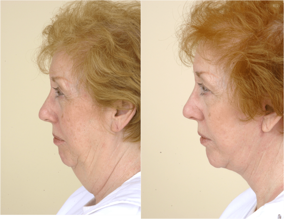 neck lift without surgery neck lift without surgery