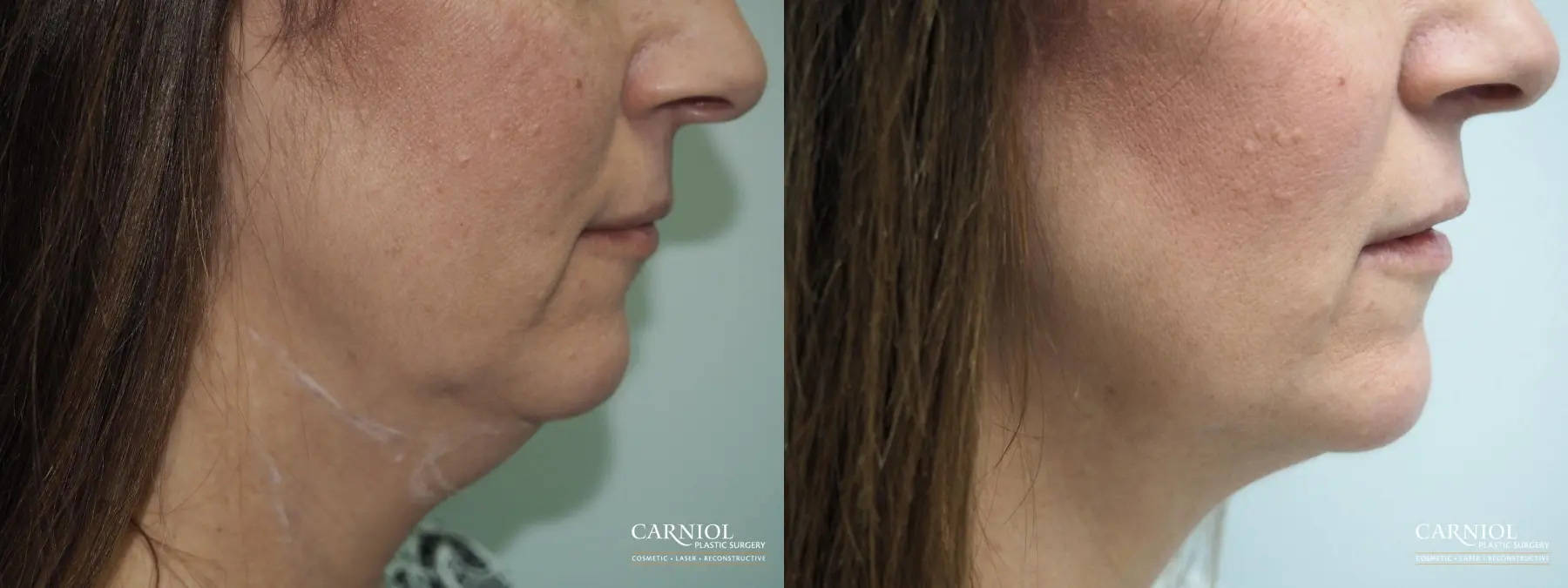 neck lift without surgery neck lift without surgery