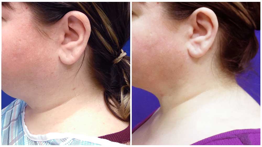 neck lipo