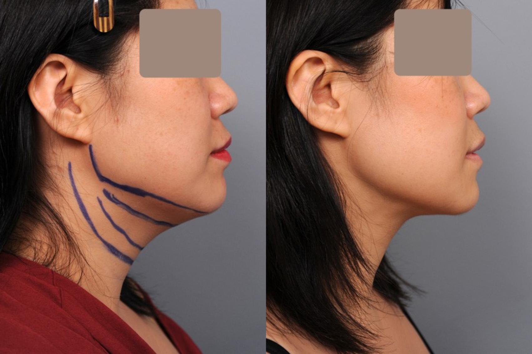 neck lipo