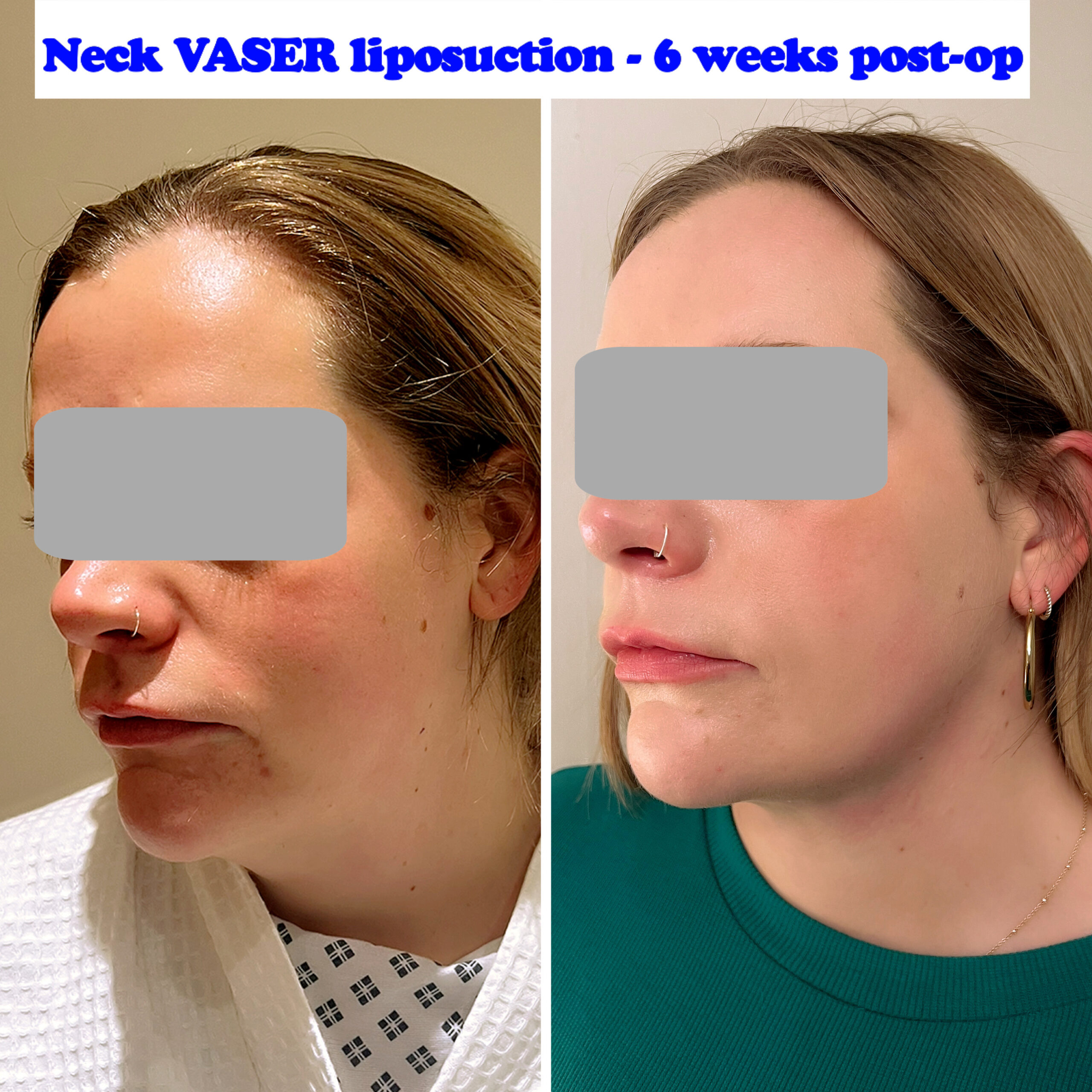 neck lipo