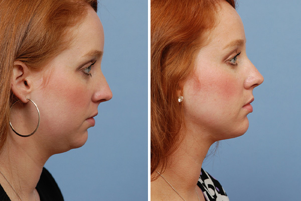 Neck Lipo: Smoothing and defining the neck