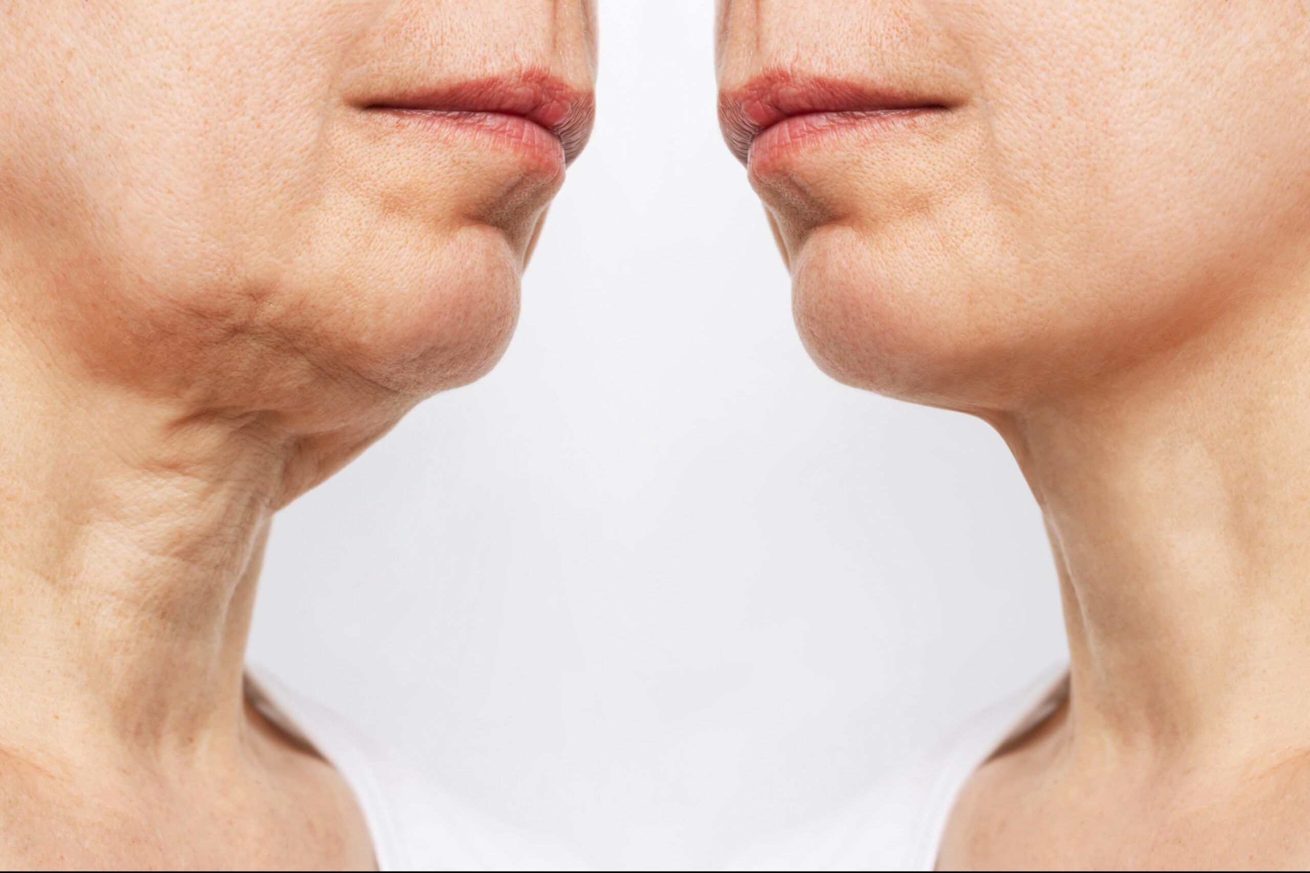 neck rejuvenation