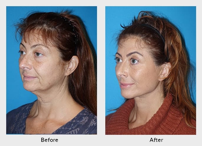 Neck rejuvenation: Reversing the signs of aging