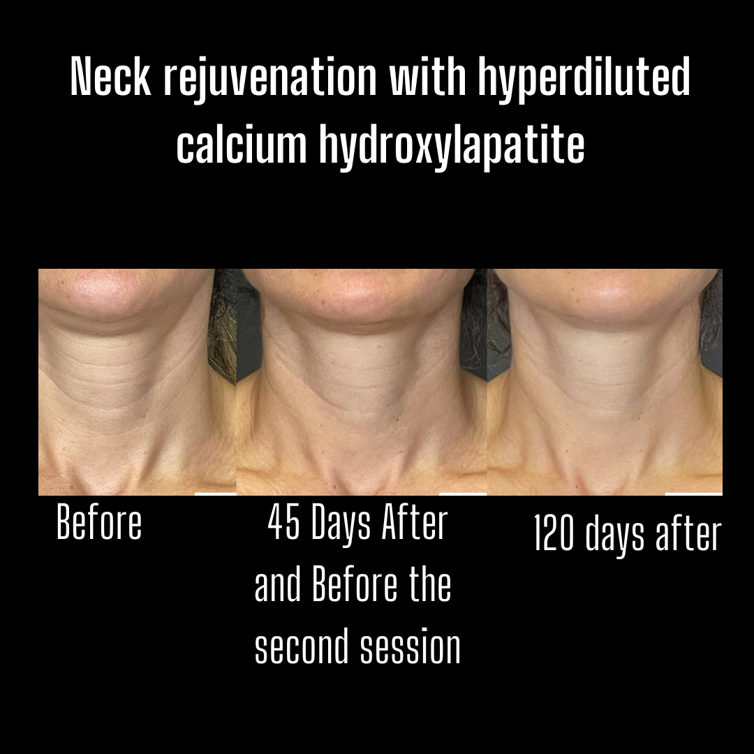 neck rejuvenation