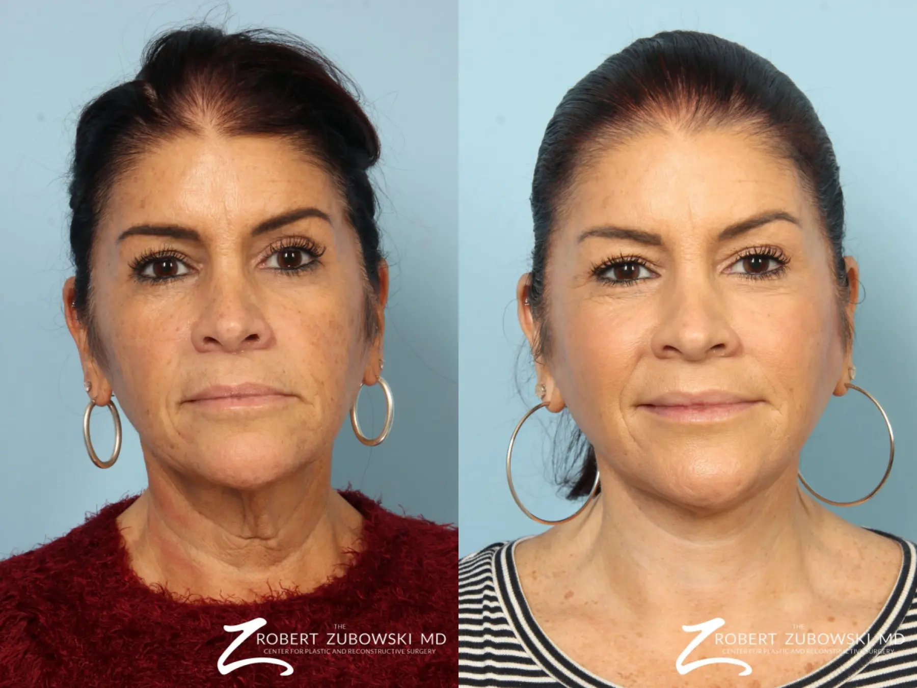neck rejuvenation