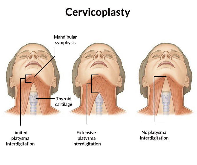 neck tightening surgery neck tightening surgery
