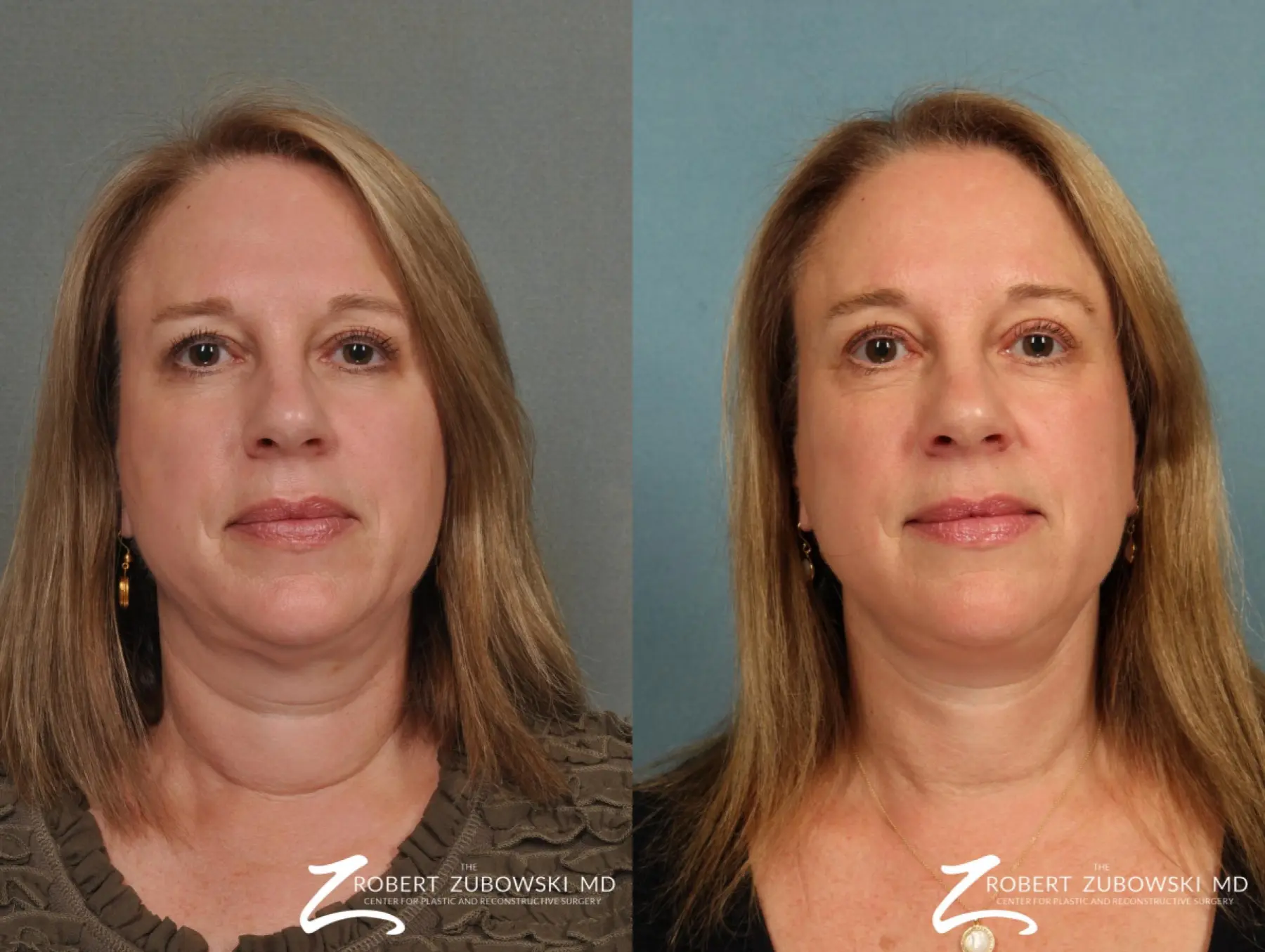 neck tightening surgery neck tightening surgery