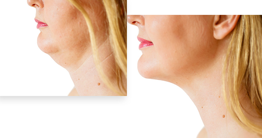 neck tuck neck tuck