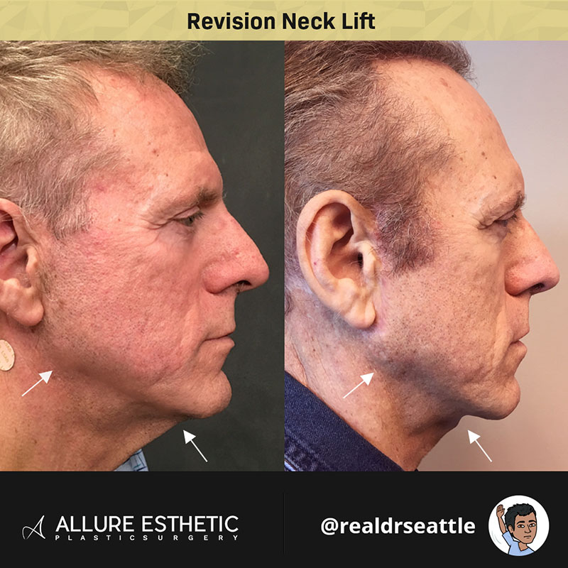 neck tuck neck tuck