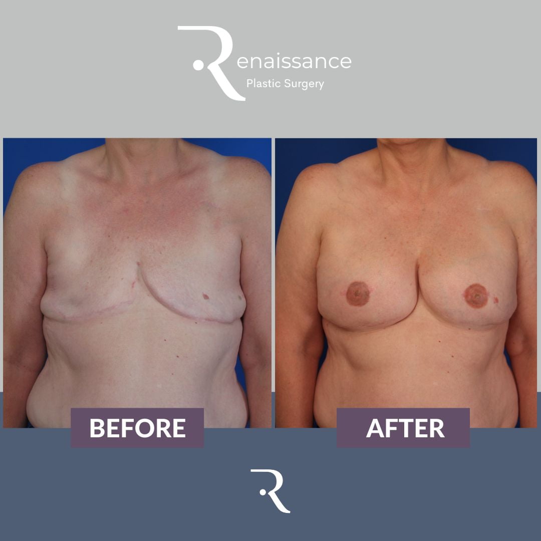 nipple reconstruction surgery nipple reconstruction surgery