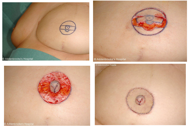 nipple reconstruction surgery nipple reconstruction surgery