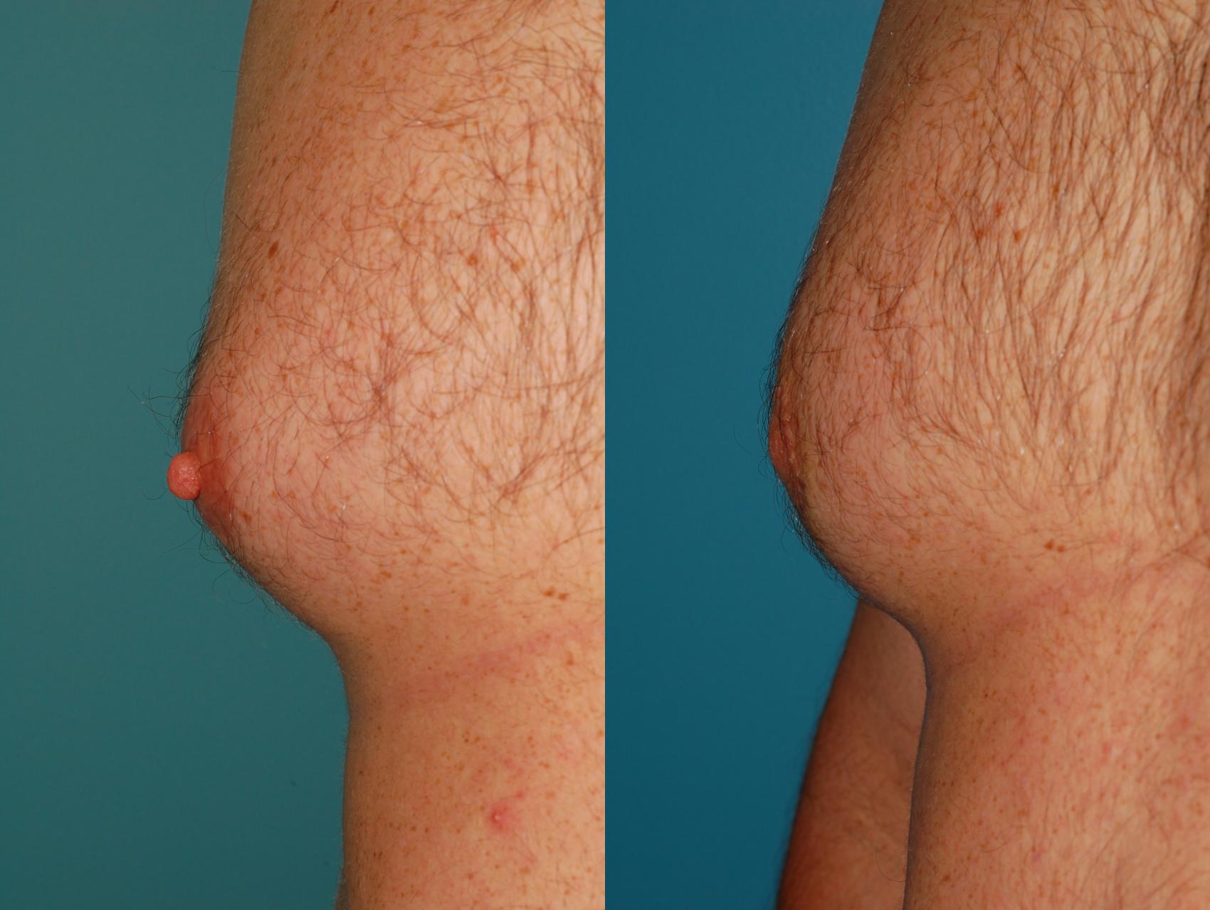 nipple reconstruction surgery nipple reconstruction surgery