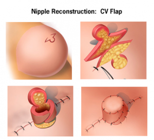Nipple reconstruction surgery: Restoring form and confidence