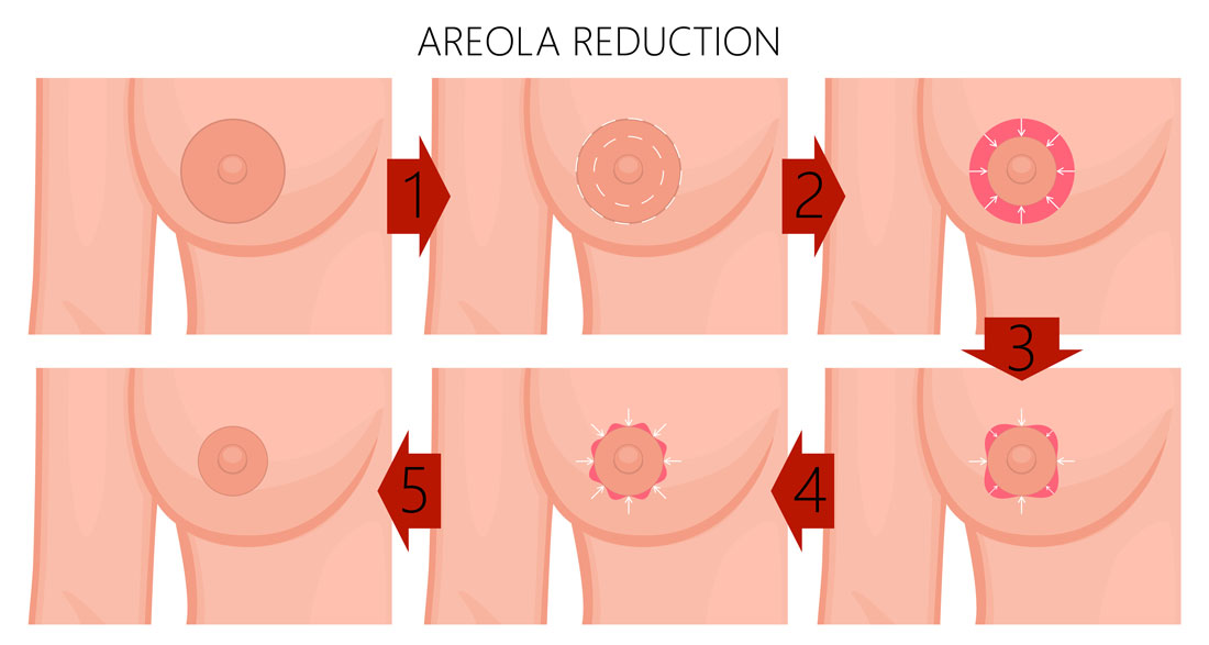 nipple reduction