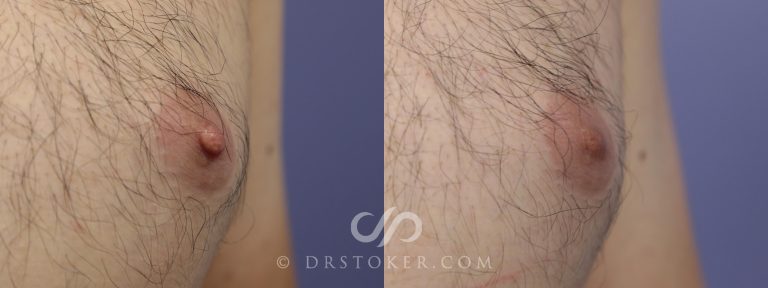 Nipple reduction: Enhancing aesthetics with precision