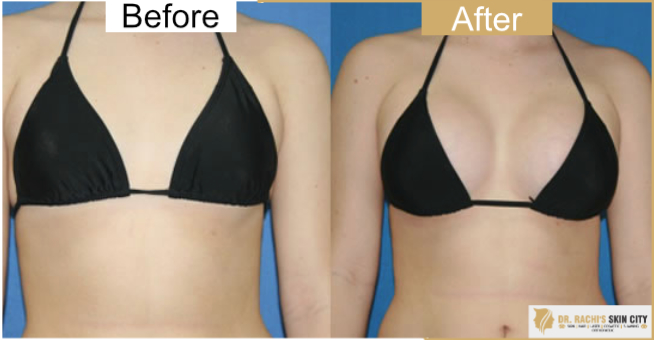 non invasive breast lift non invasive breast lift