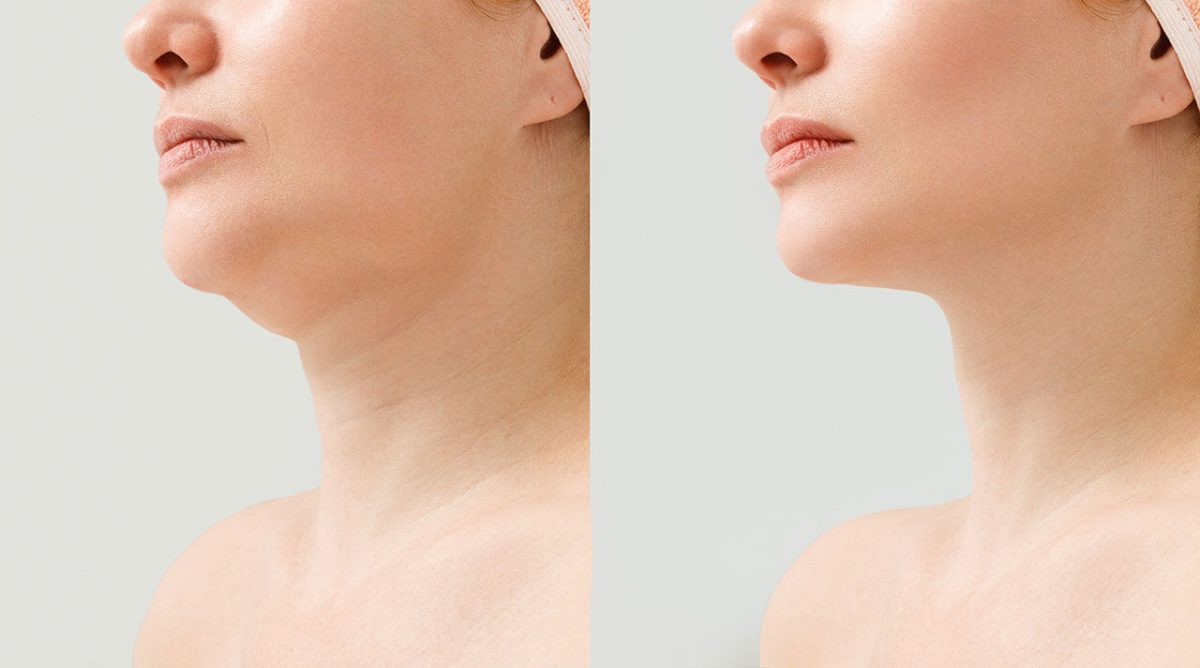non invasive neck lift non invasive neck lift