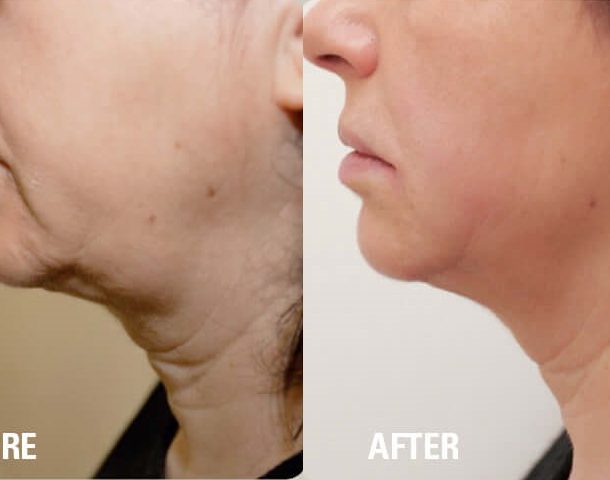 Non-invasive neck lift options for a youthful look