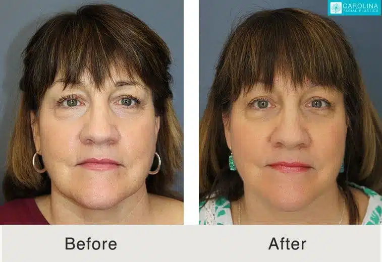non invasive neck lift non invasive neck lift