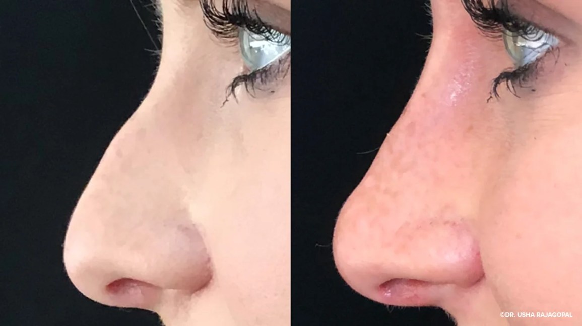 non invasive rhinoplasty