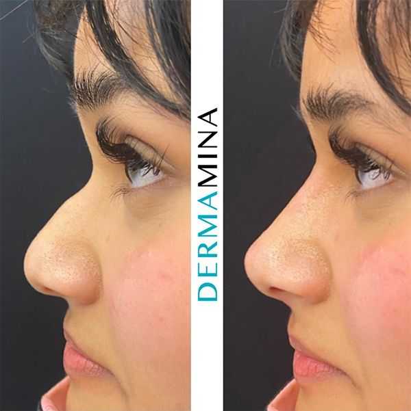 non invasive rhinoplasty