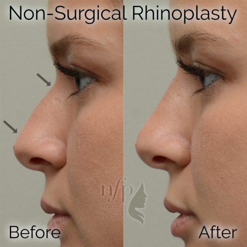 non invasive rhinoplasty