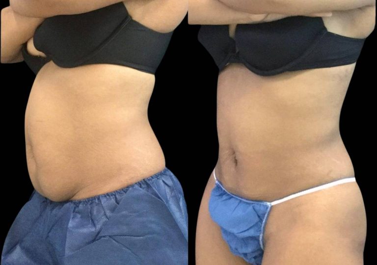 Non-Invasive Tummy Tuck Options: Are They Right for You?