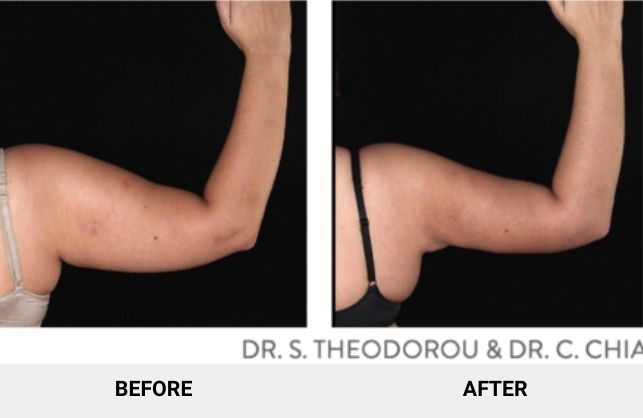 non surgical arm lift non surgical arm lift