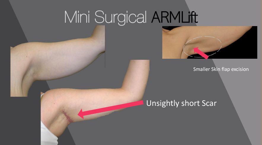 non surgical arm lift non surgical arm lift