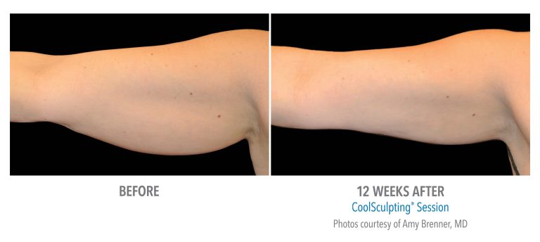 Non-Surgical Arm Lift: Tightening without surgery