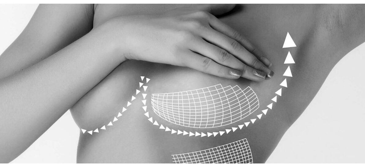 non surgical breast lift non surgical breast lift