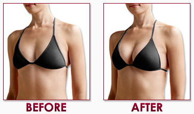 non surgical breast lift non surgical breast lift