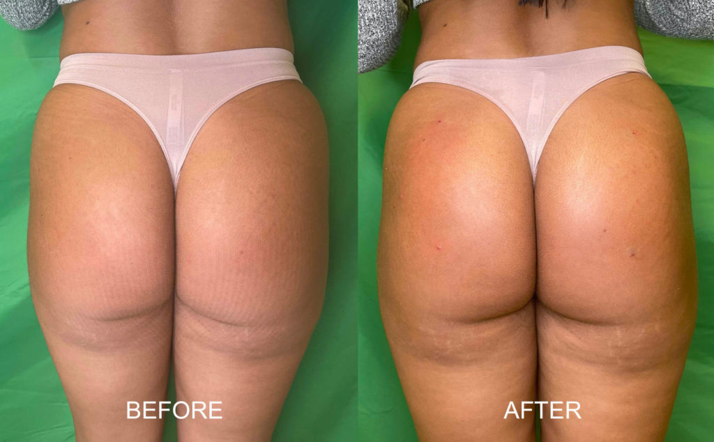 non surgical butt lift non surgical butt lift