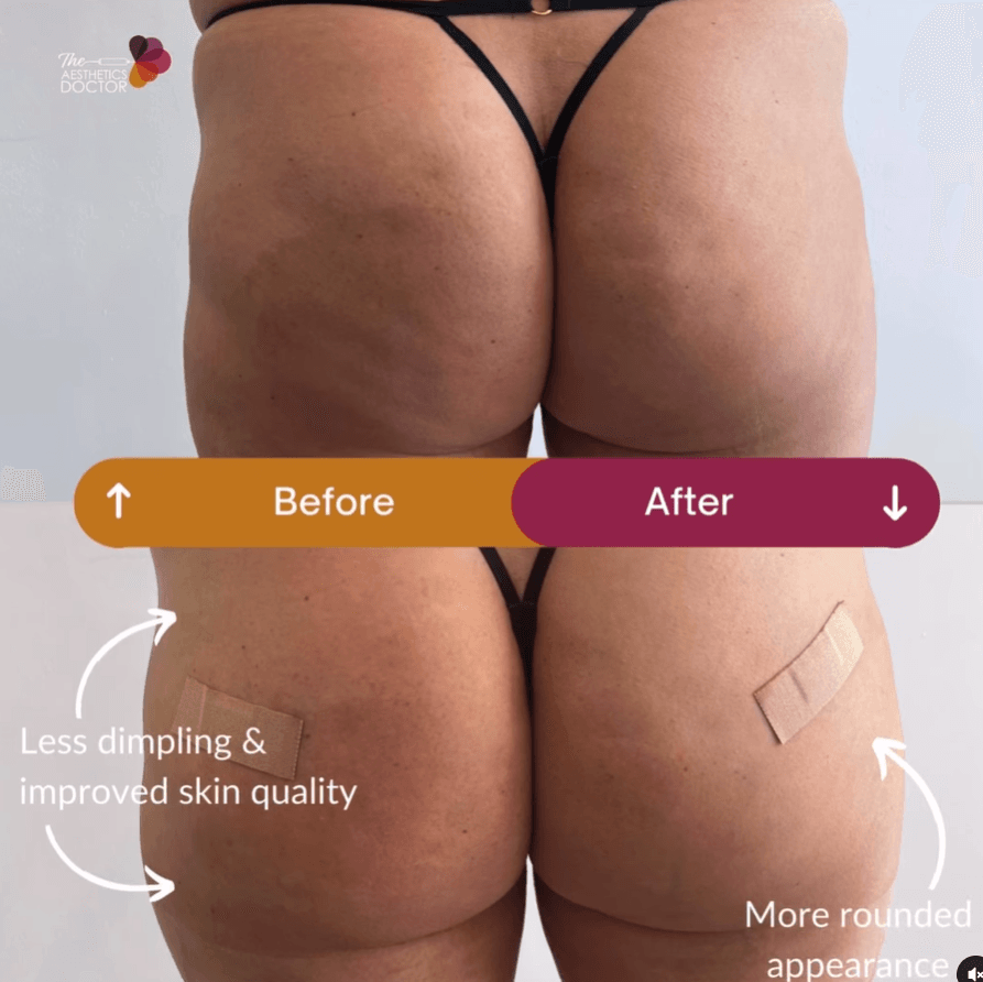 non surgical butt lift non surgical butt lift