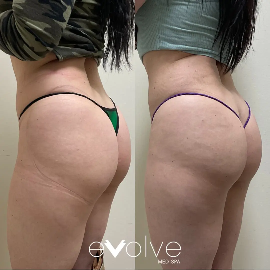 non surgical butt lift non surgical butt lift