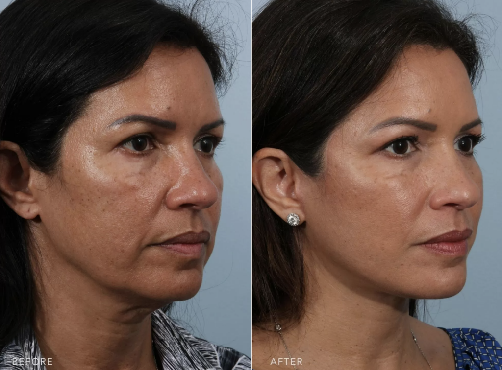 non surgical face lift cost non surgical face lift cost