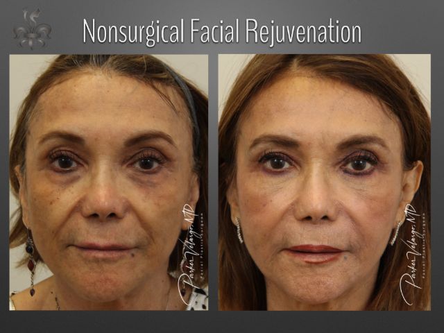non surgical face lift cost non surgical face lift cost