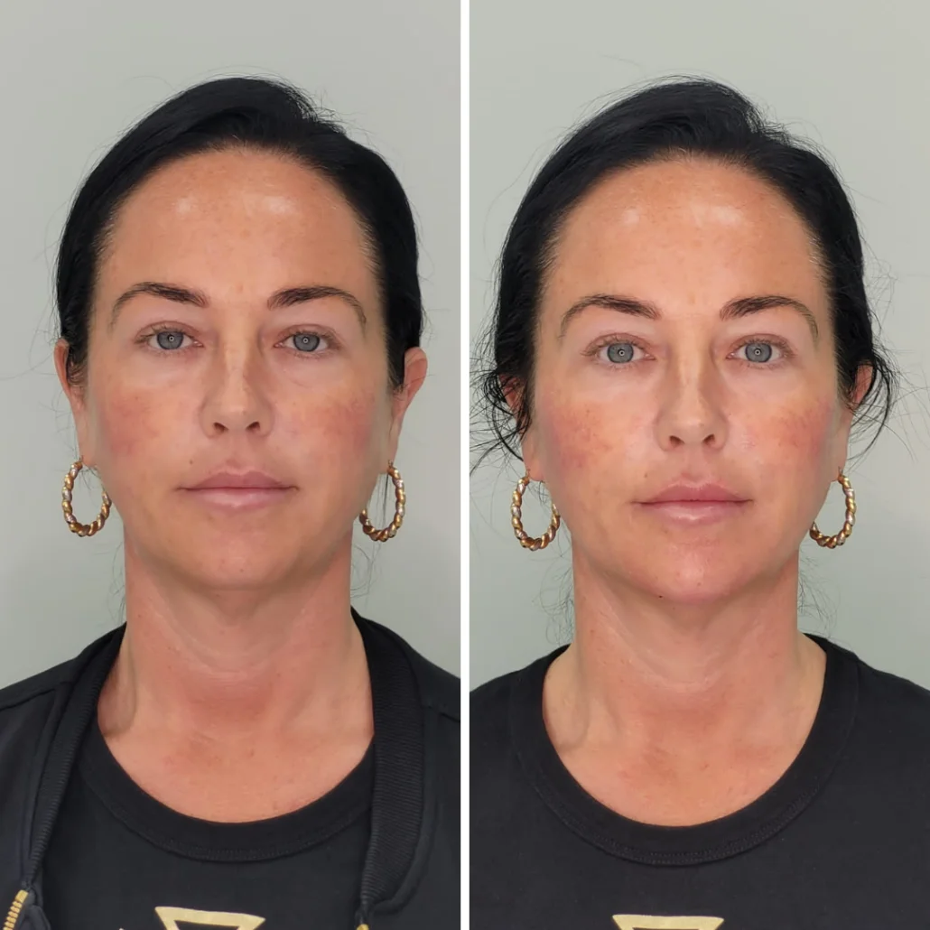 non surgical face lift cost non surgical face lift cost