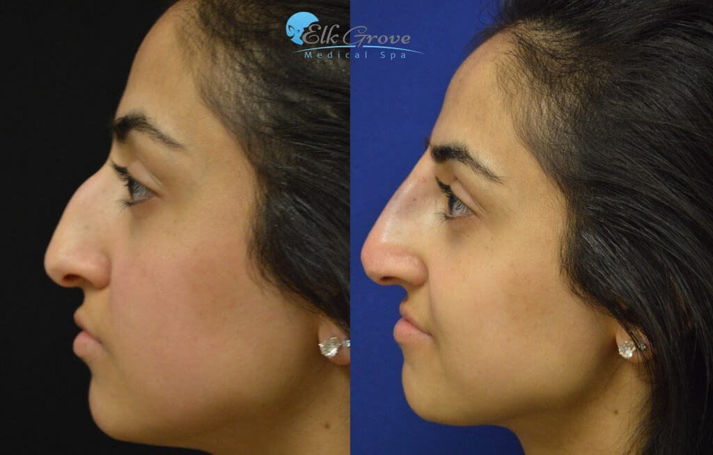 non surgical nose lift