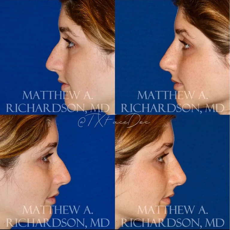 Non-surgical nose lift: Subtle reshaping with minimal downtime