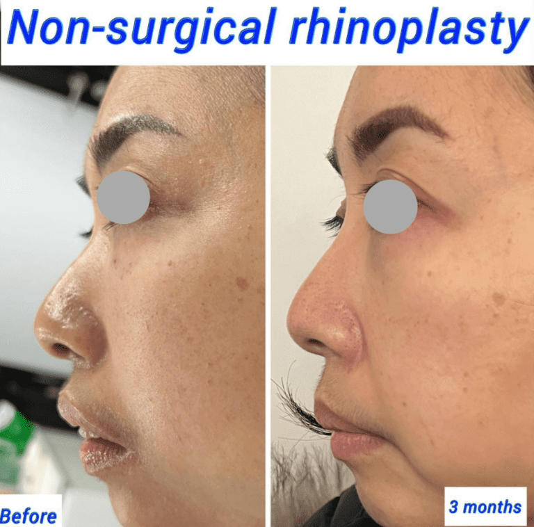 non surgical nose lift