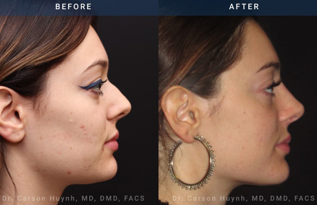 non surgical rhinoplasty cost