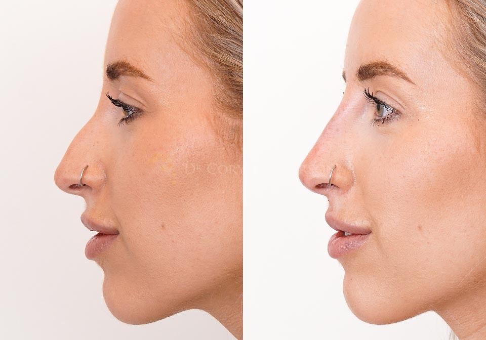 non surgical rhinoplasty cost